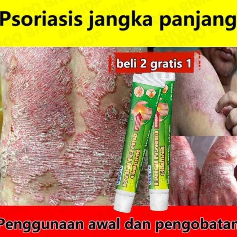 Psoriasis Cream Obat Kurap Eksim Salep Dermatitis Seboroik Salep Kadas Kurap Gatal Ampuh Salep Kulit