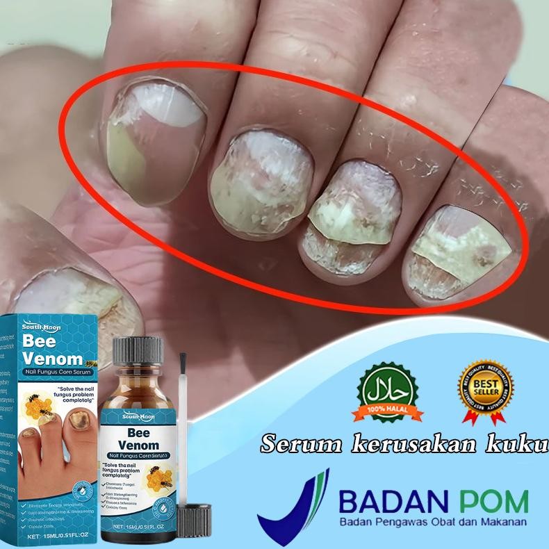 BpomSerum Kuku Jamur Dan Rusak Obat Kuku Jamur Dan Rusak Obat Jamur Kuku 15Ml Obat Kuku Rusak Paling