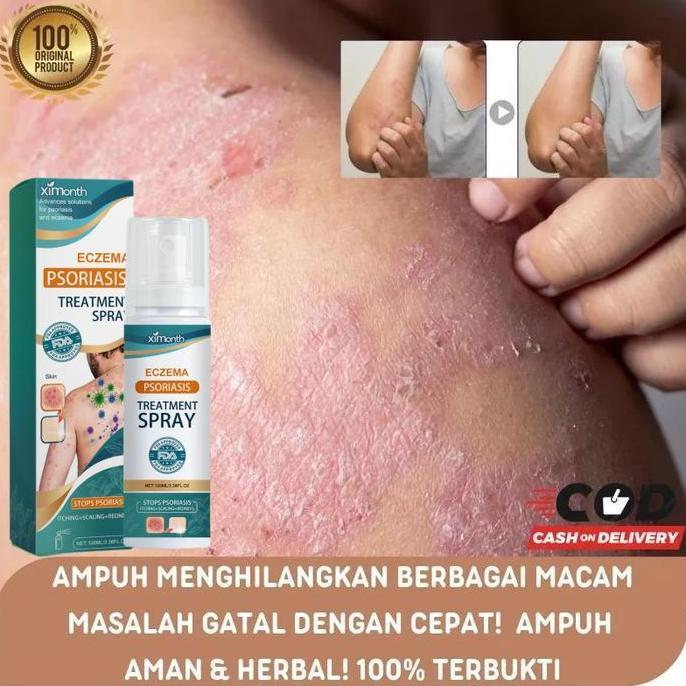 Facene- Spray Obat Gatal Di Selangkangan & Bokong | Ampuh Untuk Eksim, Psasis, Kurap, Jamur Di Area 