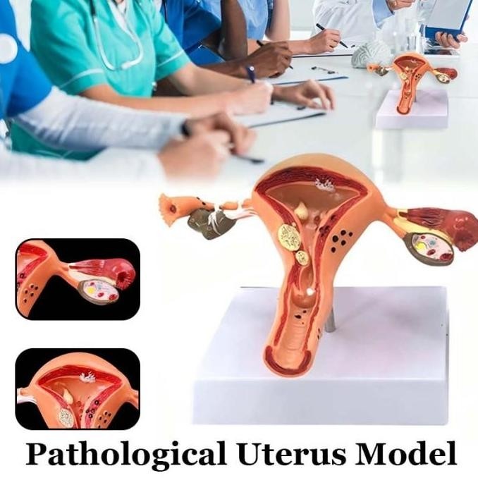 RAFENU Model Anatomical Uterus Ovary Wanita / Peraga Anatomi Model Patologis Uterus Ovarium