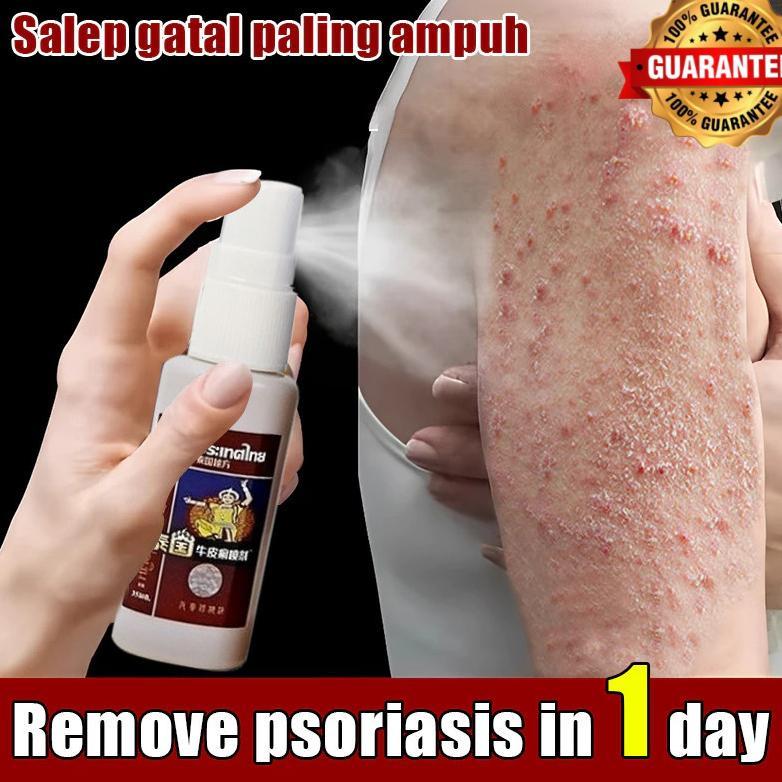 Spray gatal paling Obat obat gatal Obat Gatal gatal 35ml gatal selangan obat gatal kulit Kulit Kepal