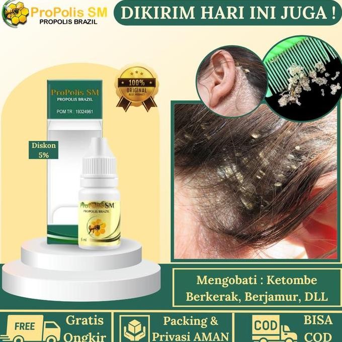 TERLARIS - Obat Ketombe Berkerak Di Kepala, Penghilang Ketombe Parah Bagus