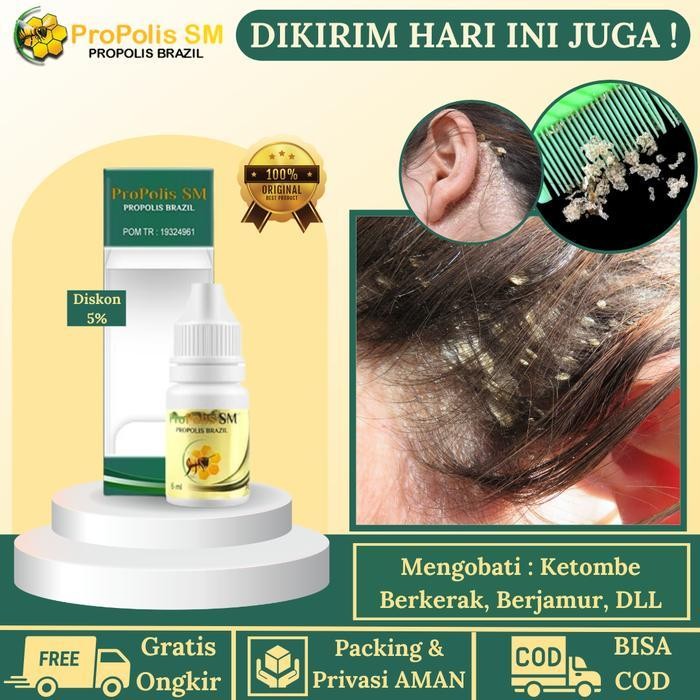 Obat Ketombe Berkerak Di Kepala, Penghilang Ketombe Parah Bagus