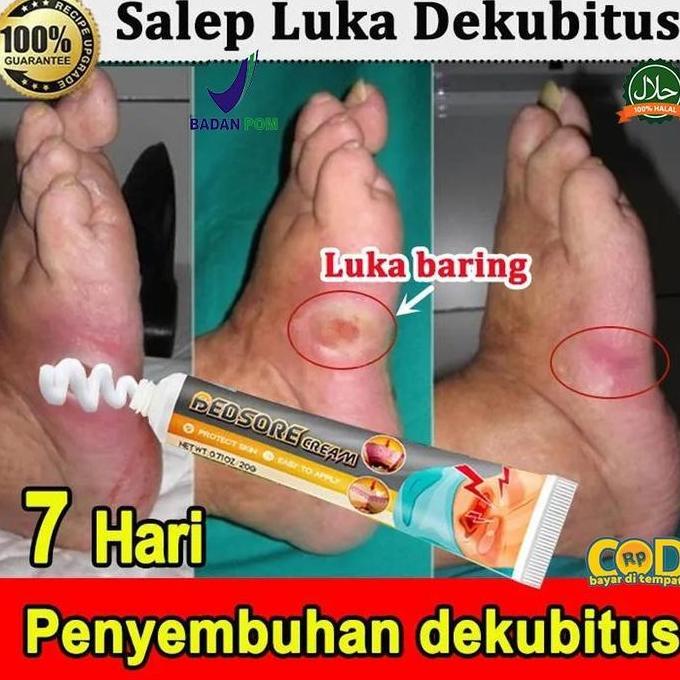 Facene- Krim Luka Baring/Penyembuhan Luka/Luka Diabetes/ Krim Dekubitus/Mengobati Dekubitus 0G
