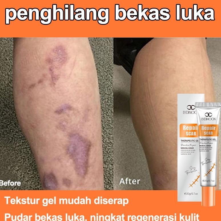 Salep Penghilang Bekas Luka Penghilang Bekas Luka Gel Bekas Luka 20G Membaiki Berbagai Bekas Luka Me