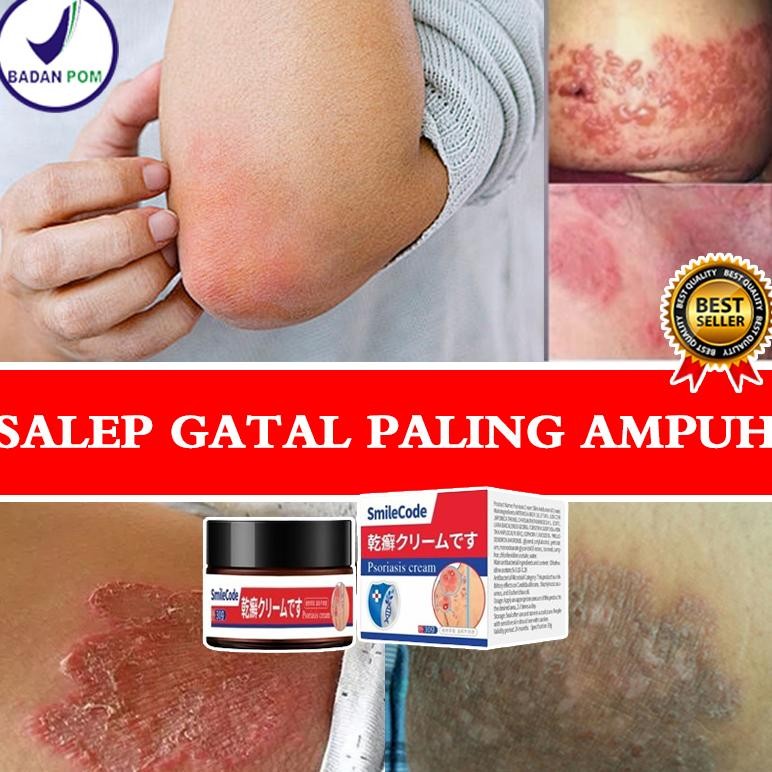 Salep Gatal Paling Ampuh Obat Gatal Selangkangan 30G Salep Gatal Selangkangansalep Gatal Pada Miss V