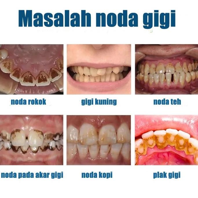 pembersih karang gigi Perontok karang gigi paling ampuh Pembersih gigi kuning dan karang Penghilang 