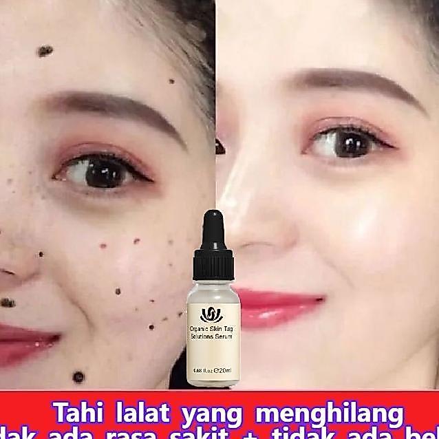 Penghilang Tahi Lalat Penghilang Kutil Penghilang Tahi Lalat Di Wajah Obat Penghilang Tahi Lalat Ski