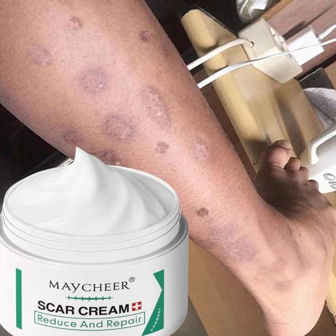 Krim penghilang bekas luka Cream penghilang bekas luka Penghilang bekas luka hitam Menghilangkan bek