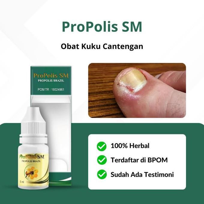 Pilihan - Obat Cantengan Jempol Kaki Bengkak, Obat Jamur Kuku Kaki, Propolis Sm