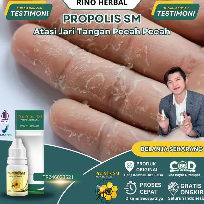 Salep Jari Tangan Pecah Pecah, Jari Tangan Kering, Jari Tangan Kering dan Pecah, Kulit Jari Tangan K