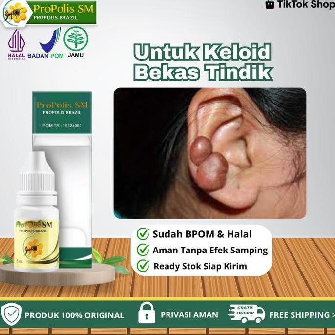 Propolis SM - Untuk Penghilang Keloid Bekas Luka Menonjol Di Telinga,  Keloid Menonjol Bekas Tindik 