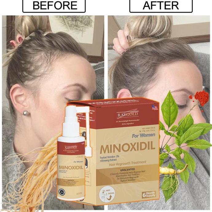 MINOXIDIL 2%for WOMEN penumbuh rambut with Ginseng extract from USA  - RAYGOLD - MINOX MINOKSIDIL an
