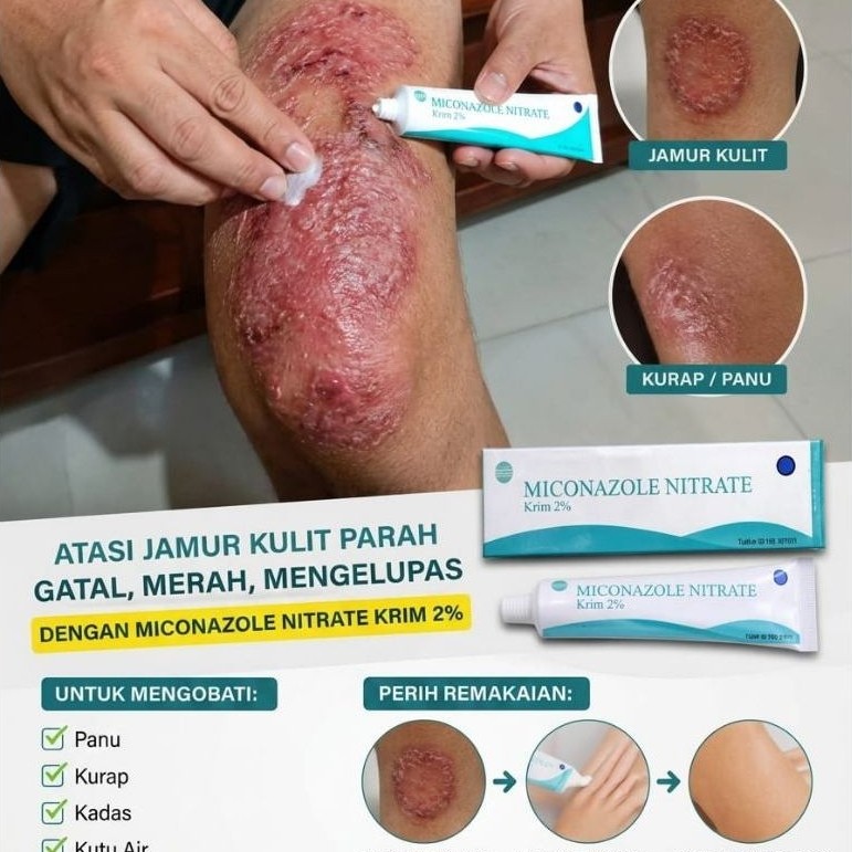 Salep Gatal Miconazole / Obat Salep Gatal Kulit / Salep Jamur Ampuh / Obat Jamur Kulit