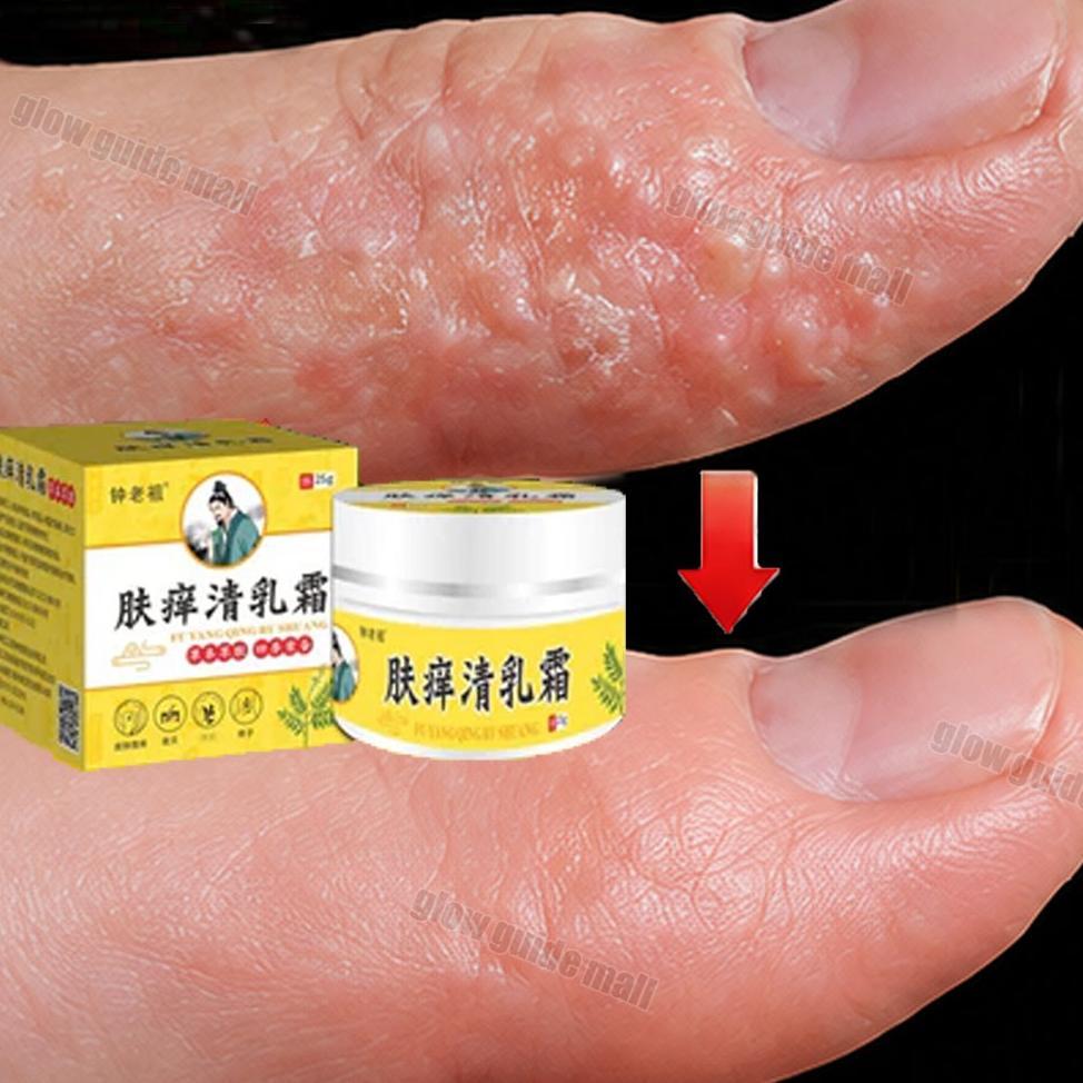 salap gatal china salep eksim kering dan gatal obat psoriasis Menghilangkan Kurap dan Jamur Diskon