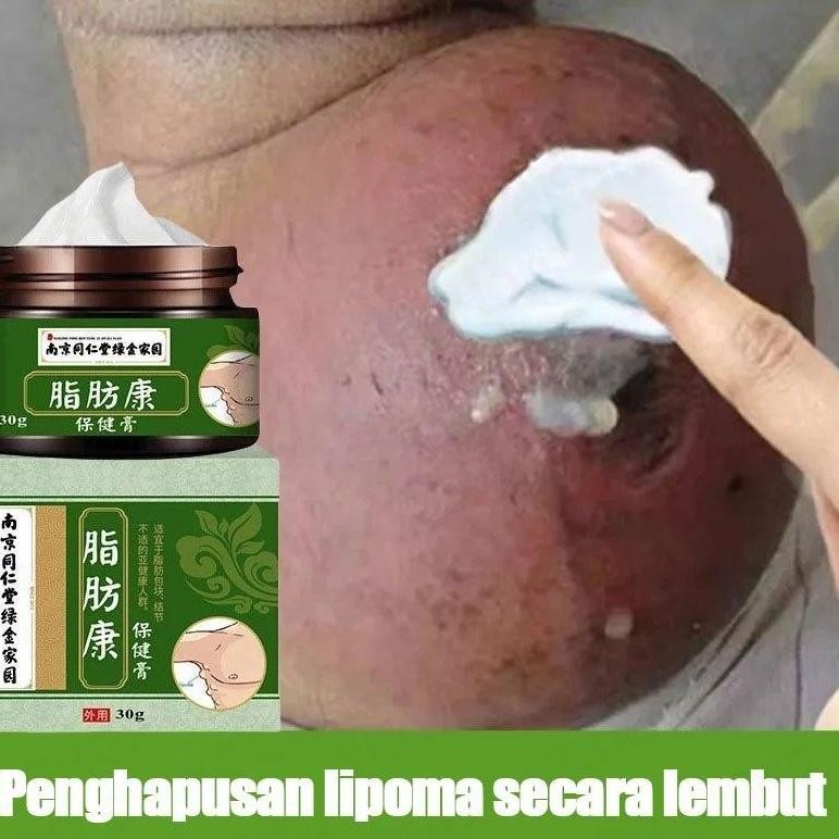 Lipoma Cream Salep Benjolan Obat Benjolan Di Lehe Krim Lipoma Lipoma Removal Cream Original Salep Li