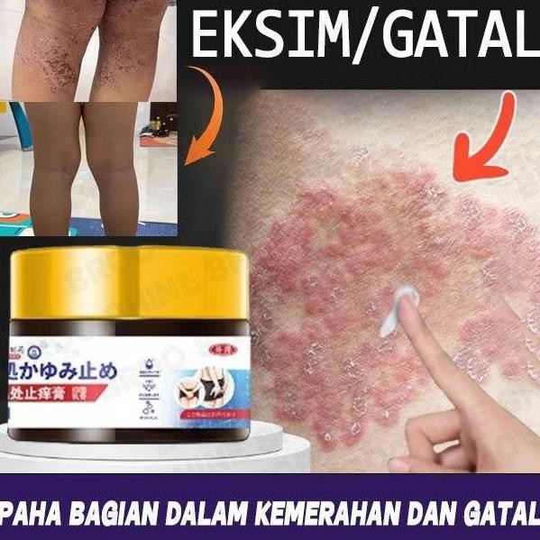 Salap Gatal Kulit Yang Ampuh Obat Gatal Selangkangan Salep Gatal Selangkangan Obat Eksim Anti Jamur