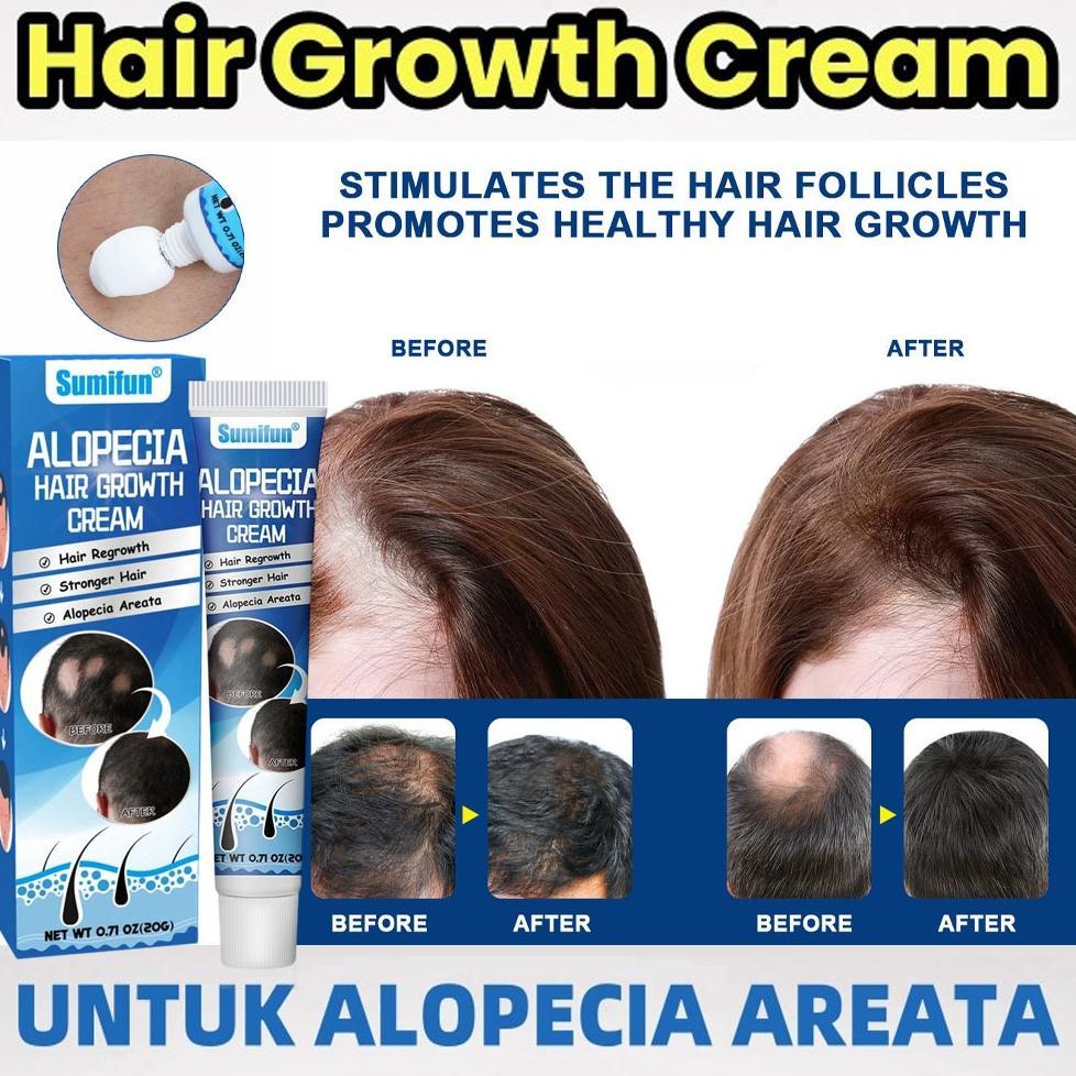 Obat Alopecia Areata, Obat Penumbuh Rambut Botak, Obat Botak Koin, Obat Banyak Pitak, Obat Rambut Pi
