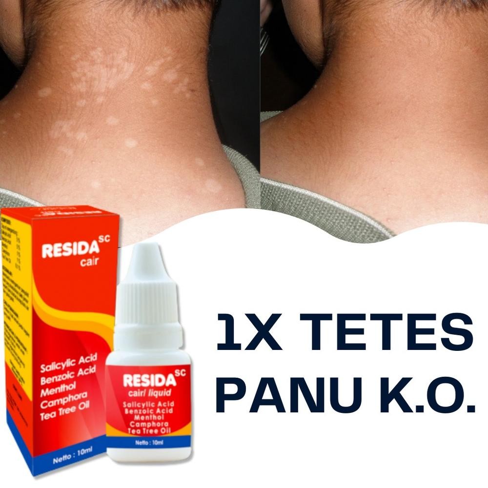 Resida Cair Obat Panu Original Obat Panu Paling Ampuh 100% Cair Original Bpom Penghilang Gatal