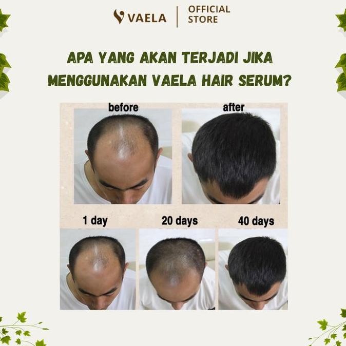 VAELA Hair Serum Serum Perawatan Rambut Rontok, Rusak & Botak | Penyubur Rambut Pria & Wanita