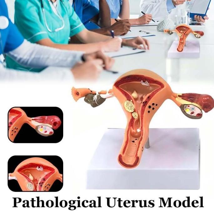 SAMBINAKA Model Anatomical Uterus Ovary Wanita / Peraga Anatomi Model Patologis Uterus Ovarium