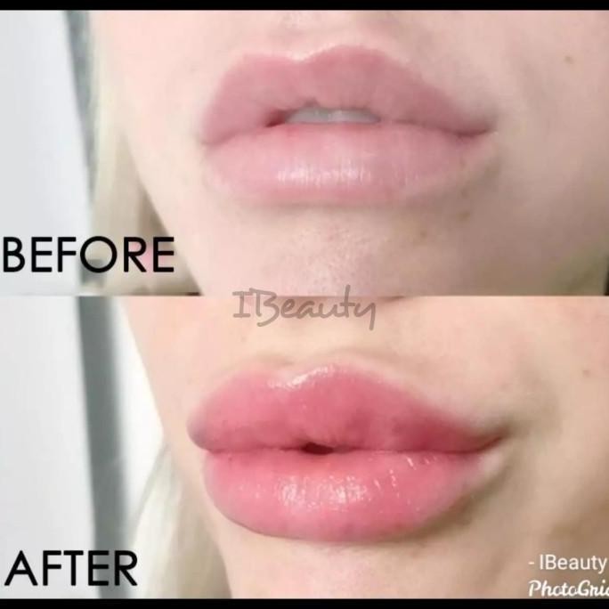 Lip Plumper/Filler Bibir [BARUU]