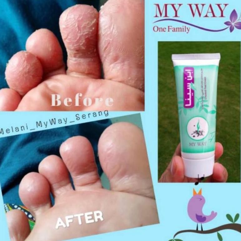 Ibnu Sina My Way Obat Krim  Untuk Gatal ,Kaki Pecah Pecah, Obat Luka Bpom
