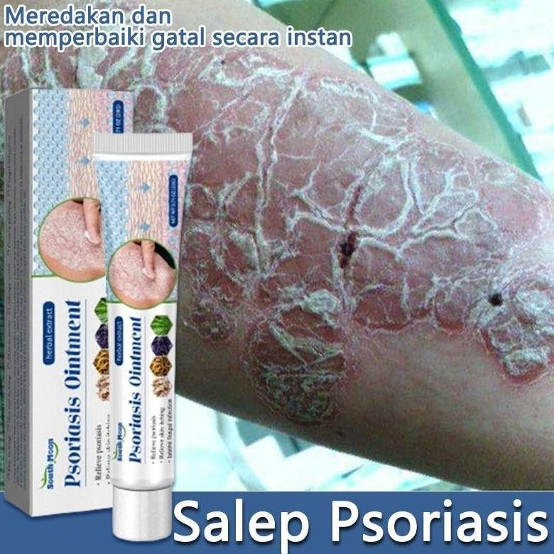 Salep Gatal Obat Kurap 20G  Obat Eksim Salap Gatal Kulit Yang Ampuh Salep Eksim Salep Psoriasis Sale