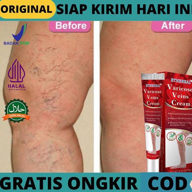Facene- Varises Lotion Herbal Obat Varises Di Kaki Varises Treatment Cream Varises Ampuh Obat Varise