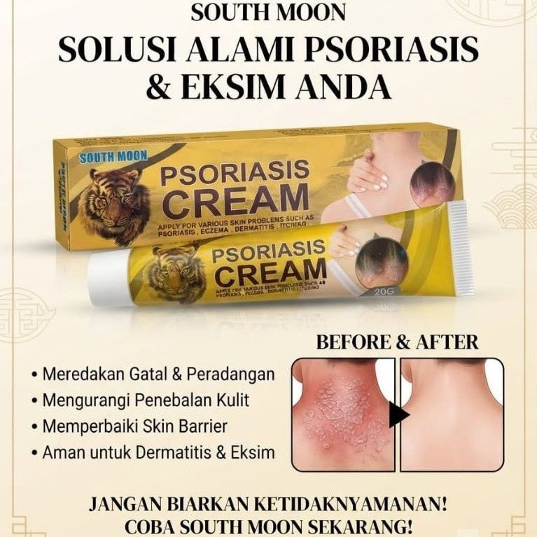 Gatal-Psoriasis Cream 20g Perawatan Kulit Herbal Cina Efektif Mengobati Infeksi Jamur / Kulit Gatal 