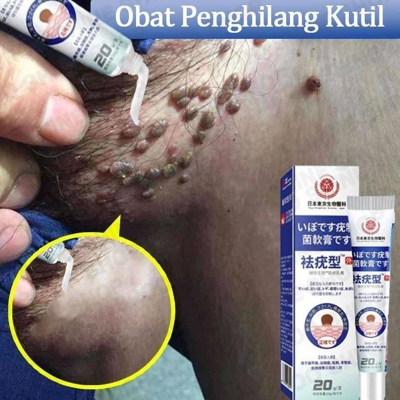 Obat Penghilang Kutil Dan Tahi Lalat Salep Kutil Paling Ampuh Wart Removal Kutilos Untuk Wajah Dan L