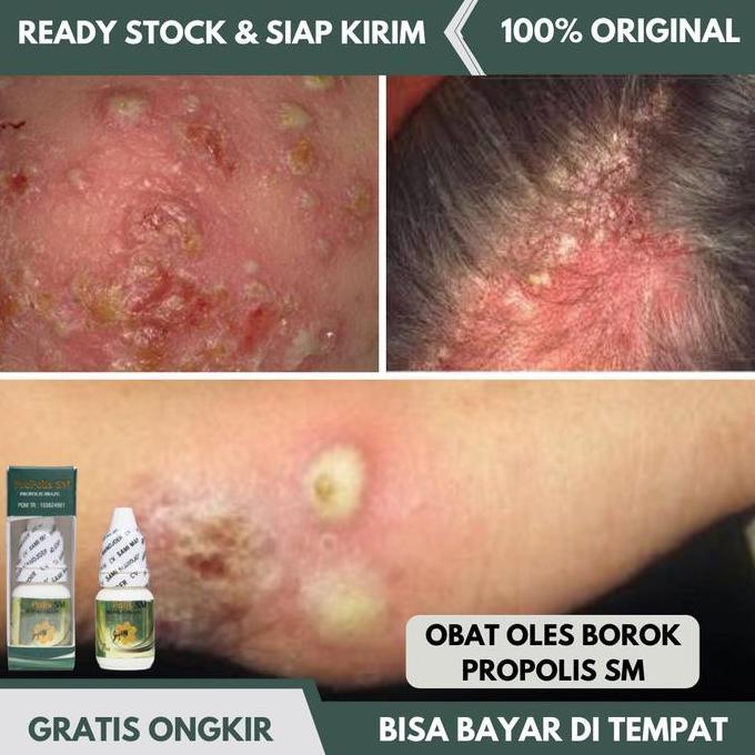 Obat Oles Borok, Obat Borok Di Kaki, Borok Di Kepala, Borok Bernanah
