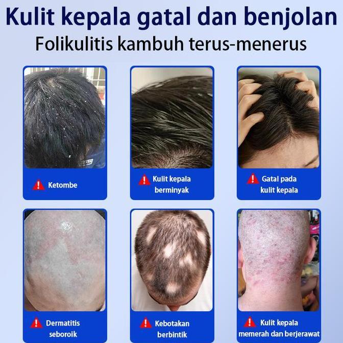 Haircare- Dr.March Kenazol 2 Sampo Anti Ketombe & Gatal, Anti Rontok,Mengontrol Minyak I Mencegah Ra