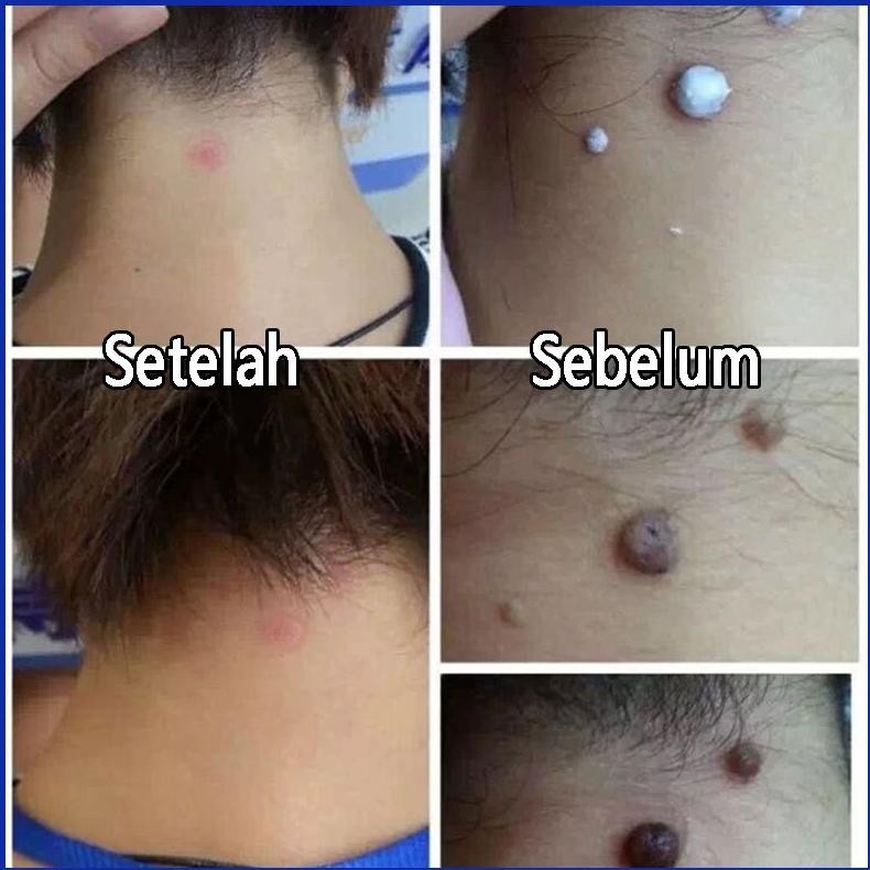 Penghilang Kutil Dan Tahi Lalat Obat Penghilang Kutil Di Wajah Papiloma Wajah Kutil Leher Penghilang