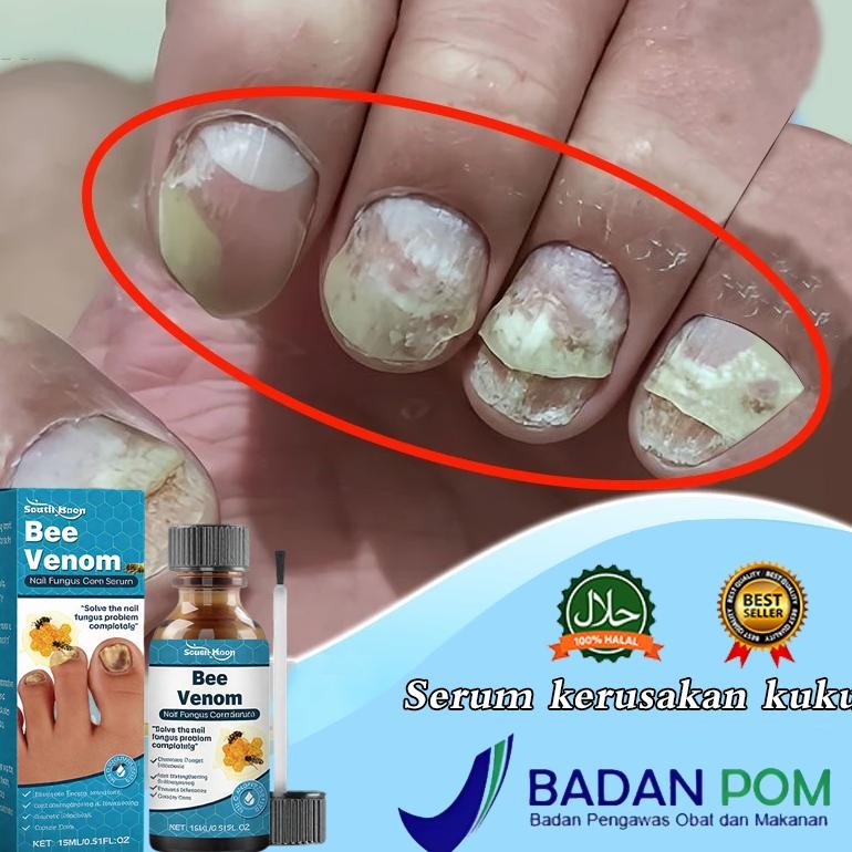 BpomSerum Kuku Jamur Dan Rusak Obat Kuku Jamur Dan Rusak Obat Jamur Kuku 15Ml Obat Kuku Rusak Paling
