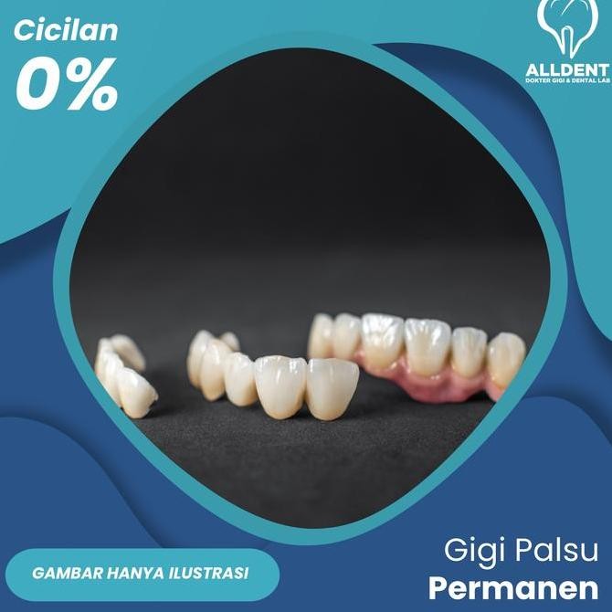 Gigi Palsu Permanen Crown