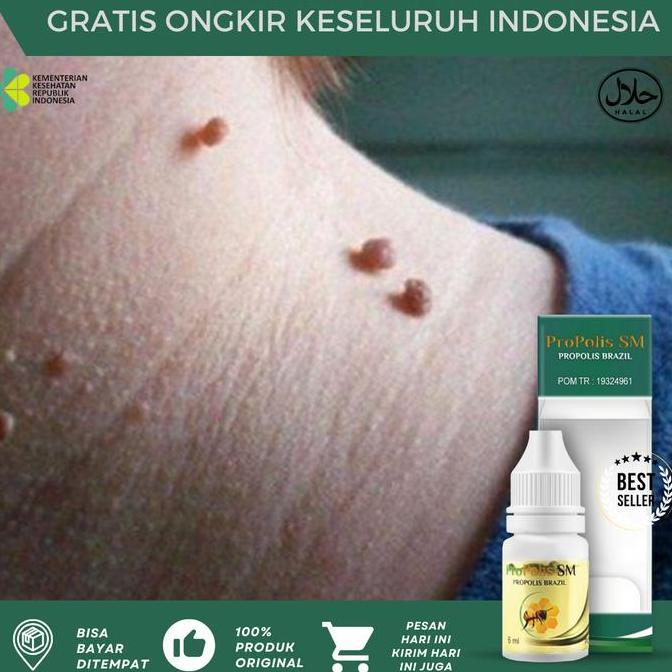 JAR_FASHIOM - KUTIL PAPILOMA DI LEHER, PERONTOK KUTIL DILEHER, PENGHILANG PAPILOMA, PAPILOMA DI WAJA