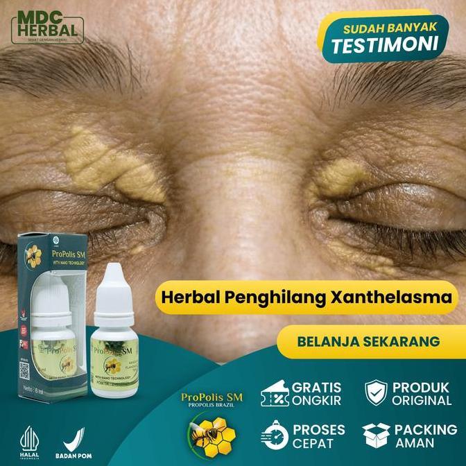 JAR_FASHIOM - HERBAL PENGHILANG XANTHELASMA, HERBAL OLES XANTHELASMA KELOPAK MATA, GUMPALAN LEMAK DI