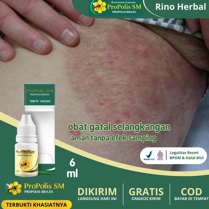 ProPolis SM Herbal Selangkangan Hitam, Gatal Selangkangan, Gatal Kelamin, Gatal Pada Kulit Eksim Ber