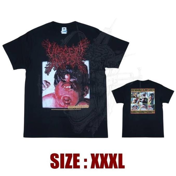 TS - VISCERA INFEST - Sarcoidosis