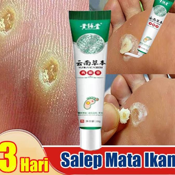 LAZZBUINA - SALEP MATA IKAN TELAPAK KAKI /OBAT PENYAKIT MATA IKAN / OBAT MATA IKAN PADA TELAPAK KAKI