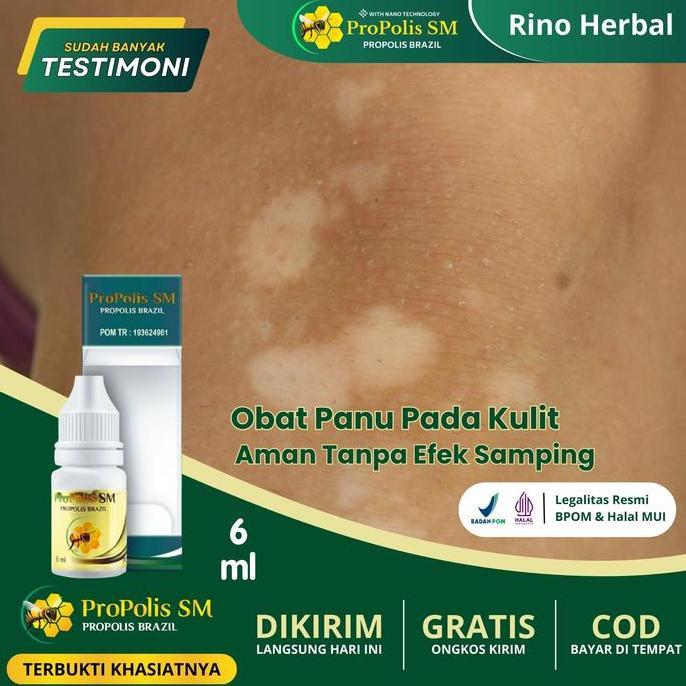 Promo Obat Panu Pada Kulit, Obat Pengilang Panu, Obat Panu Cair, Obat Jamur Kulit, Obat Panu Di Waja