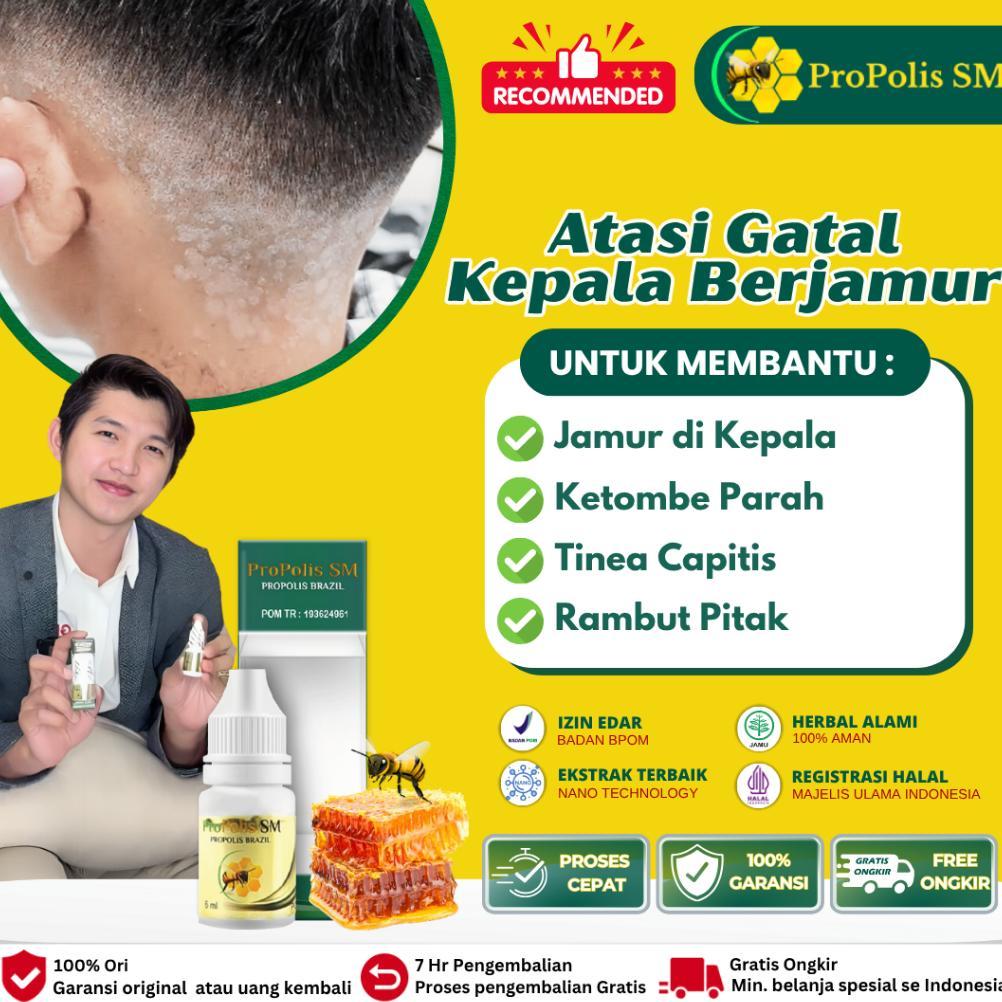 Obat Oles Jamur Di Kulit Kepala, Kepala Berjamur, Gatal, Kulit Autoimun, Obat Botak Koin, Rambut Pit