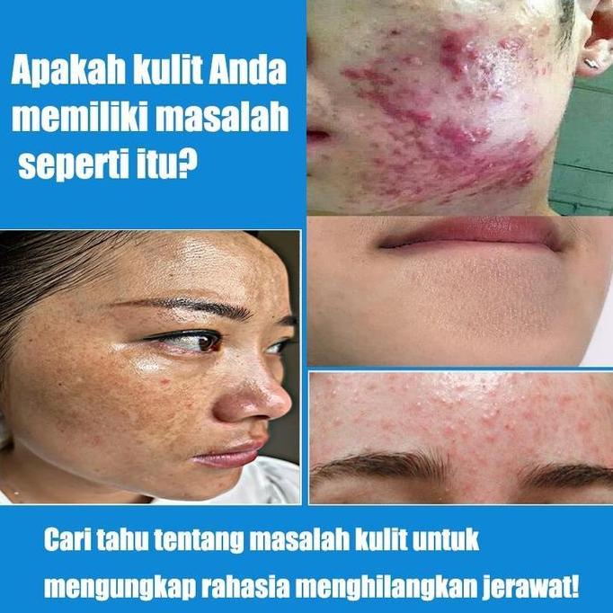 Acne Cream Salep Jerawat Dan Bekas Removal Cream Obat Jerawat Gel Bekas Jerawat Lotion Acne Cream Sa