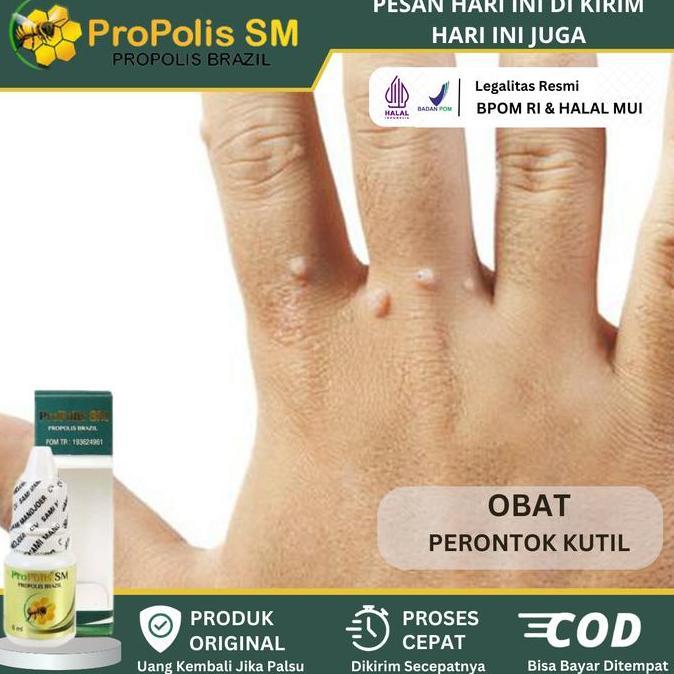 Perontok Kutil, Kutil Di Leher, Perontok Kutil, Kutil Di Wajah, Papiloma, Kutil Di Tangan, Kutil Kel