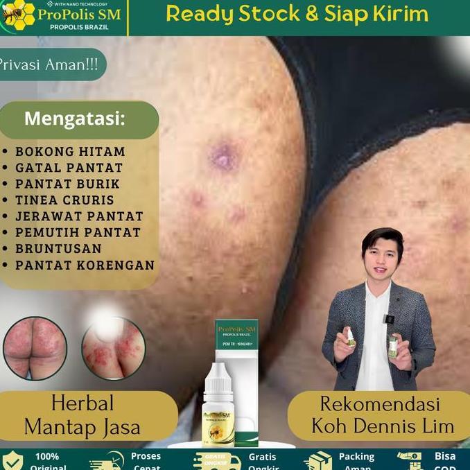 Kenk- Propolis Sm - Salep Pantat Burik Hitam, Gatal Pantat, Korengan Di Pantat, Pemutih Pantat, Tine