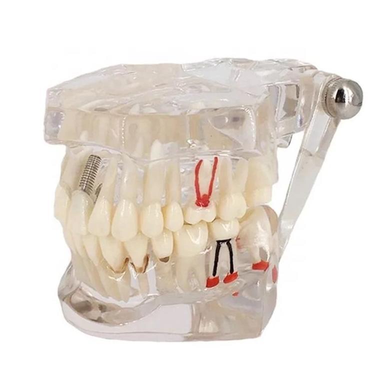 Model study gigi edukasi transparan studi implant phantom crown karies bridge bening impaksi model g