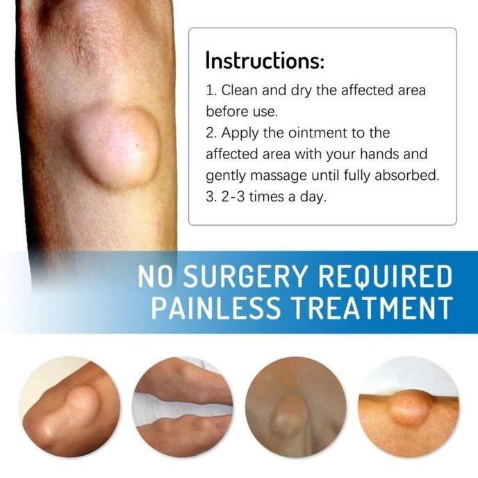 Healt- Obat Benjolan Lipoma Salep Benjolan Tiroid Cream Penghilang Lipoma Herbal 20G Krim Lipoma Cre