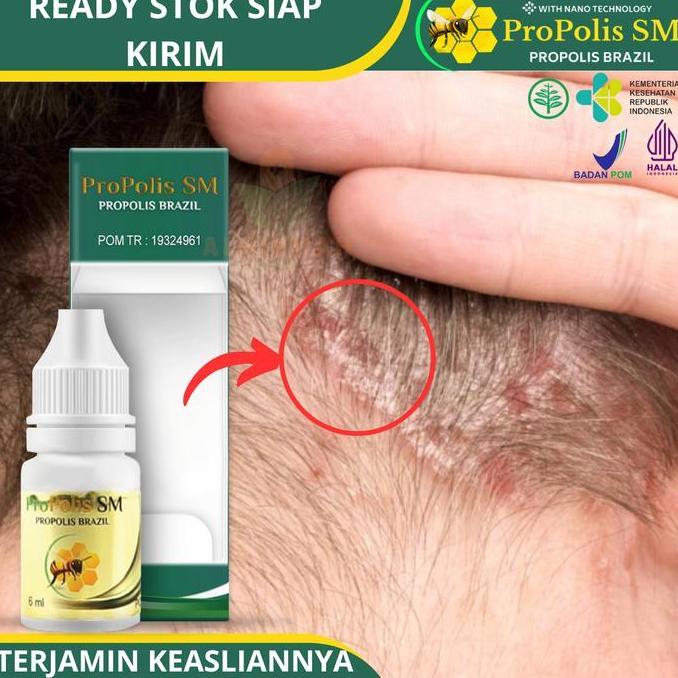 Letssist- Propolis Sm - Salep Cair Untuk Koreng Gatal Di Kulit Kepala Karena Ketombe Berkerak Dan Be