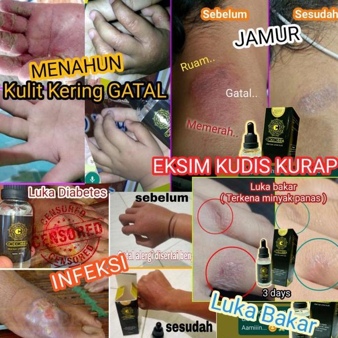 Vitbig- Obat Kadas Kurap Eksim Kudis Paling Ampuh Obat Gatal Selangkangan